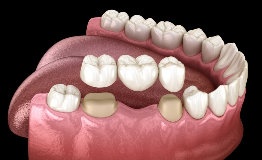 dental-bridges-classics-dental-panmure-auckland